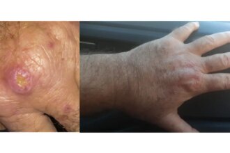 especialistas-alertam-para-a-falta-de-informacao-sobre-a-leishmaniose