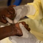brasil-registra-88-casos-de-mpox-em-2026;-saiba-como-evitar-a-doenca