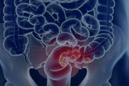 rastreamento-para-cancer-colorretal-pode-ser-implementado-no-sus