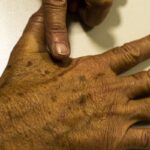 desinformacao-sobre-cancer-de-pele-afeta-diagnostico,-diz-instituicao