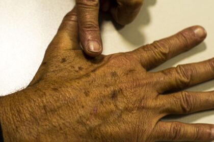 desinformacao-sobre-cancer-de-pele-afeta-diagnostico,-diz-instituicao